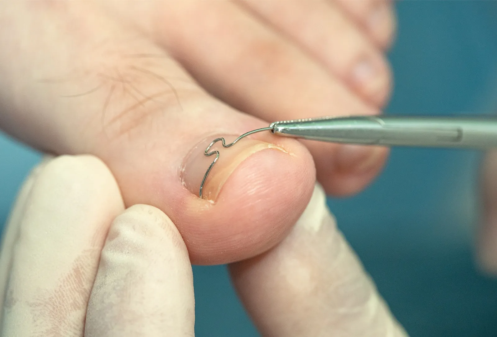 Une infirmière pose un clip correcteur sur un ongle incarné